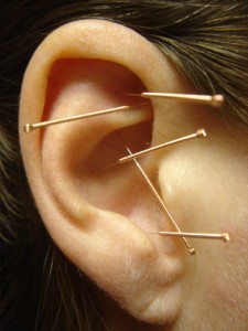 Ear Acupuncture Hawaii