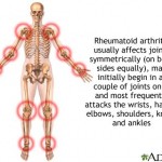 Arthritis and Acupuncture