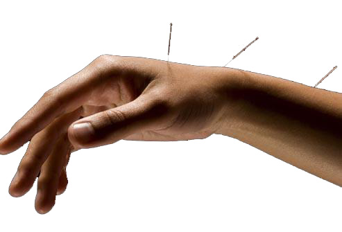 Carpal-Tunnel-Acupuncture
